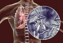 Tuberculosis Outbreak? The Ancient Disease Reappears