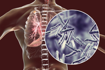 Tuberculosis Outbreak? The Ancient Disease Reappears