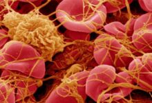 Worldwide Embalmer Survey: 250 Embalmers Report Finding White Rubbery Clots