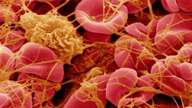 Worldwide Embalmer Survey: 250 Embalmers Report Finding White Rubbery Clots