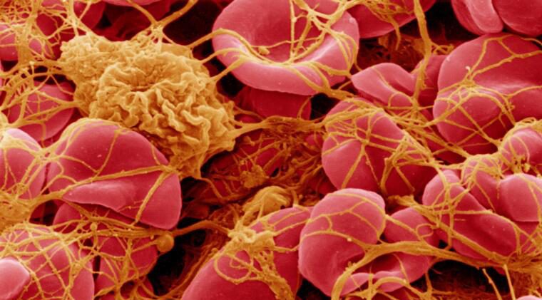 Worldwide Embalmer Survey: 250 Embalmers Report Finding White Rubbery Clots Worldwide Embalmer Survey: 250 Embalmers Report Finding White Rubbery Clots