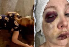 Cincinnati beatdown victim reveals ‘very bad brain trauma’ in first remarks since viral assault