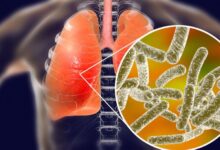 Two Die In Legionnaires Outbreak